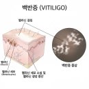 루미인피부과의원 | 눈가, 얼굴 백반증, 엑시머 레이저 치료 후기