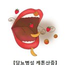 당뇨병성 케톤산증 증상 원인1형 당뇨 합병증 이미지