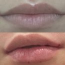 탑메디피부과의원 | 명동역피부과 올클리닉 올의원 - 입술필러 입꼬리필러 왕왕추천 / 나 왜 이제야 받았지?!