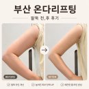 라인 | 부산온다리프팅 팔뚝 바디 라인변화 내돈내산 후기