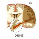 진구성뇌경색, 왜 진단비 면책 되나?......진단비 면책 질환?! 이미지