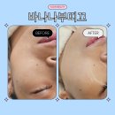 스킨바나나 | 광장동 피부관리 | 피부가 달라졌어요✨ 바나나부띠끄 군자점 더블큐어 관리 리얼 후기