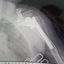 팔의 장해[인공관절이나 인공골두를 삽입한 경우][무배당 멀티플러스 종합보험1004] 이미지