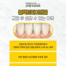 구본준치과 교정과 치과의원 | 수성구교정치과 치아교정 후 블랙트라이앵글?