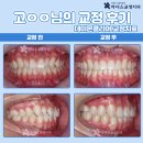 효정치과의원 | 라미네이트 치료와 함께 이루어진 치아교정치료, 마곡역치과추천