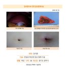 담석증수술후기. 배꼽을 이용하여 하나의 구멍으로 담석 제거가 가능하다고 하는 블로그 리뷰를 보게 되었고 상처가 적으며... 이미지