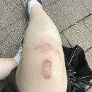 조은안약국 | 내가 22살에 무릎 수술을 3번 할 수 있었던 이유