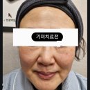 양정한의원 | 양정 🌸한의원 기미치료후기