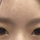 위너 | [공지] [수술후기] 위너확장구멍 제거 수술후기 1탄