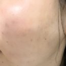 압구정 피부과 화장뜸 잡아주는 리즈네스킨부스터 생생 후기(통증,가격 등)