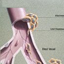 울산 척추 관절 박병원, 전이, 척추로의 암의 전이 (metastasis) 이미지