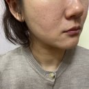 리쥬란 HB 스킨부스터 후기 맞으면 바로 피부 광 나는 줄 알았는데...