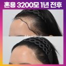 [20대 여자 M자헤어라인 혼용 모발이식] 3200모(절개2500모+비절개 히든컷 700모) 1년후기 (모엠의원/헤어라인/전지훈원장) 이미지