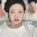 그유명한 온Da 레이저 리프팅 6만줄 효과 유지기간 후기 내돈내산