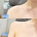강남 피부과 직각 어깨필러 후기 유지기간 부작용 가격