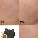 오토7 | 셀프 오토 MTS 0.5mm 2차 7일차 후기 (여드름, 홍조, 모공, 붉은기, 목주름)