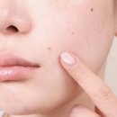 케어플러스메디칼(주) | 올리브영 1위 트러블 흔적케어, 초밀착 스팟 흔적 관리는 케어플러스 트러블 흔적 패치!