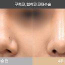 리스펙성형외과의원 | 인중코, 짧은코연장, 복코교정, 비주연장, 인중각교정, 비공비대칭교정+내측미세인중축소 - 리스펙성형외과