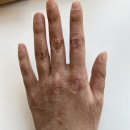 진메딕스 | [화상그후이야기] 사고 4년후 상태, 추가정보 및 추천제품