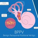 이서이비인후과의원 | 대구 시지 이서이비인후과에서 이석증 치료받은 후기와 정보 정리