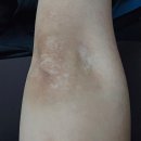 SST | 팔꿈치 백반증 sst 치료 후기 '-'*