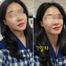 강남역 물광주사) 비타란 주사 맞고 온 후기💡+ 노티드 크리스마스 도넛🎀&lt;젤 성형외과&gt;