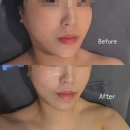 (주)케어포스 | 선릉리프팅케어와 선릉모공축소 동시에, 아이오마클리닉 솔직 후기