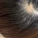 평화치과의원 | 강남역 피부과의원 두피 검버섯 레이저 제거 후기, 내돈내산 가격, 통증, 웨이팅