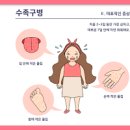 수족구병 원인 잠복기 전염 소아 유아 수족구병 전염 수두와 차이점 이미지