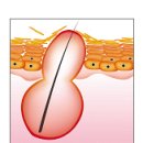 ★ 여드름 - 여드름이 생기는 이유 이미지