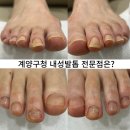 내성발톱발톱무좀관리김수정뷰티 이미지