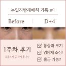 용암약국 | [눈밑지#1] 눈밑지 통증으로 미라클모닝 하게 된 후기