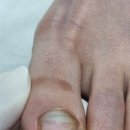 레푸스순천 | 순천발톱무좀 관리, 레푸스 순천점에서 달라진 발톱 상태 후기