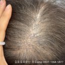 8 | ﻿일산정수리문신 8개월차 후기