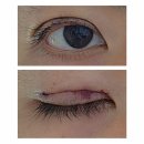 11620-5-14-6 | ㄴㅅㅎ성형외과 쌍수 1일~14일 후기, 관리 팁(아이씰, 다이소 눈찜질): 남자 짝눈 쌍수 6편