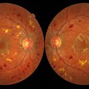 미남애프터눈안과의원 | [진료일지] "눈앞이 뿌옇고 얼룩져 보여요" 10년 차 당뇨 환자의 뒤늦은 안과 방문.