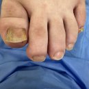 오스본병원 | 군포 파고드는 발톱무좀 병원 치료 실손 청구로 부담 덜었어요