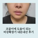 내돈내산, 코코픽 코골이 비강 확장기 사용 후기