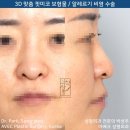 만성 비염 / 3D 맞춤 보형물 핏미 수술 후기 【Dr. 아베크 코성형】