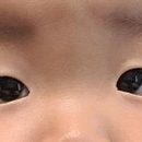 바른눈서울안과의원 네이버블로그