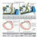 운동부하 심전도 검사 이미지
