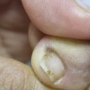 오라클윤소영피부과의원 | 인천 구월동 피부과 오라클의원에서 사마귀 냉동치료하고 발톱무좀 핀레이저 한 후기<<
