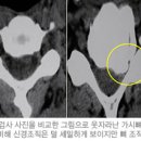 목 디스크의 증상 이미지