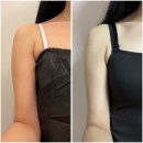 멍캣 | 팔뚝 지방분해주사 가격 멍 매직캣 3회차 효과 후기