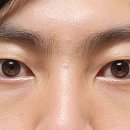 [후기] 인천 구월동 성형외과 ㅌㅇㅇ. 남자 눈및지방 재배치 이미지