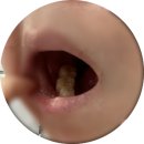 제물포J(제이)플란트치과의원 | [미아역/서울J플란트치과] 두번째 하는 임플란트 솔직후기!