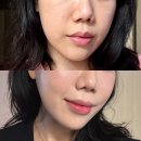 바로라인 | 신사역피부과 올타이트리프팅 처진 얼굴 턱라인 바로 달라진 효과 후기 티타늄 비교