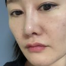 플랜 죽전점 | 대구 죽전역 피부과 리쥬란 줄기 세포 스킨부스터 맞고 온 솔직후 기