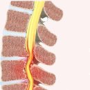 척추관협착증(Spinal Stenosis) 이미지