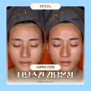 강남논현 피부관리 나날스킨 강남본점 슈퍼젝션 모공성형 가격 후기